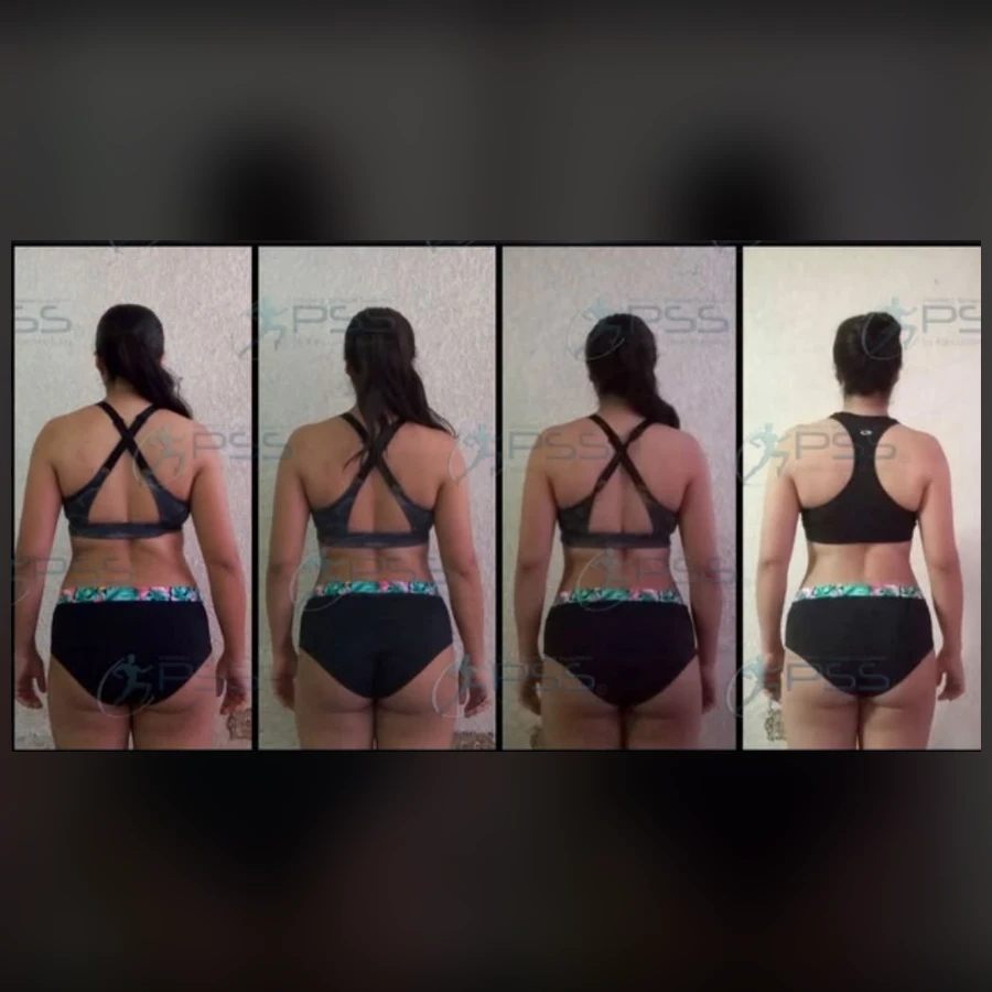 Testimonio Lipo Reductor - Reducción Progresiva Torso Posterior