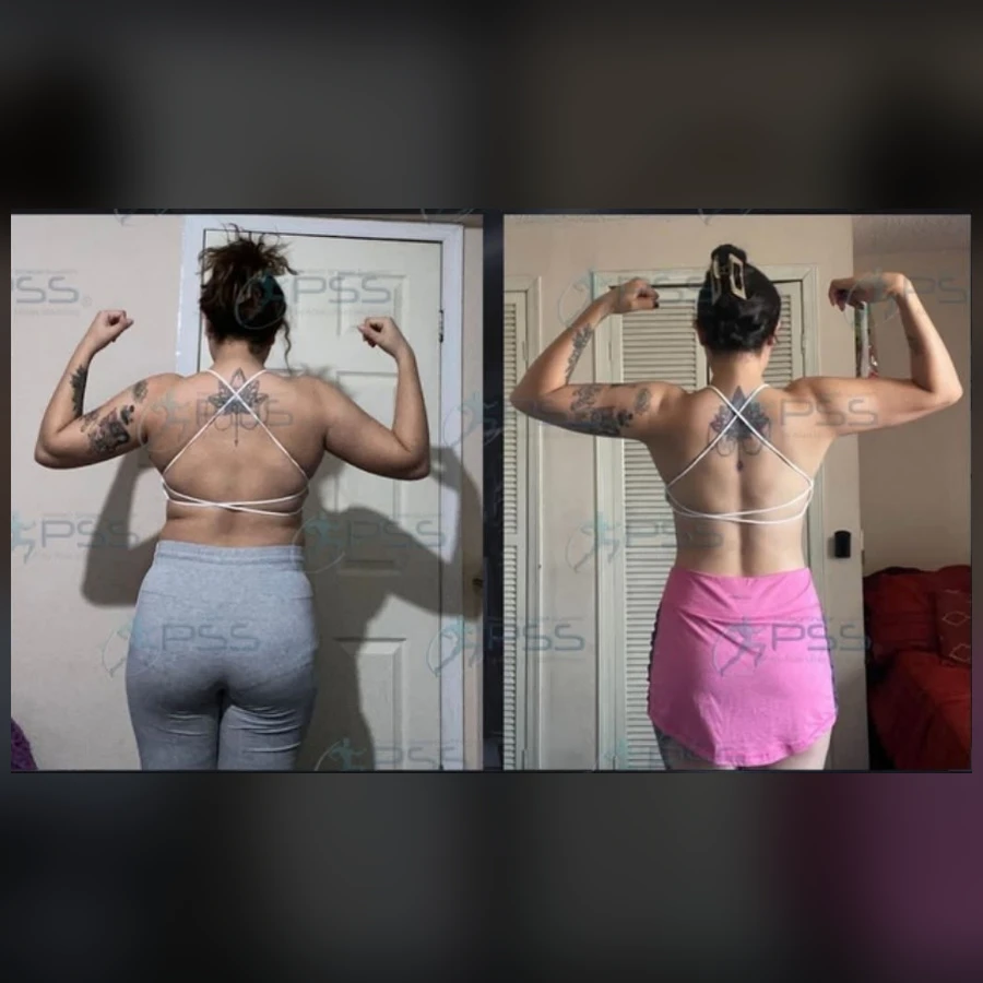Testimonio Lipo Reductor - Reducción de Pliegues y Tono Dorsal