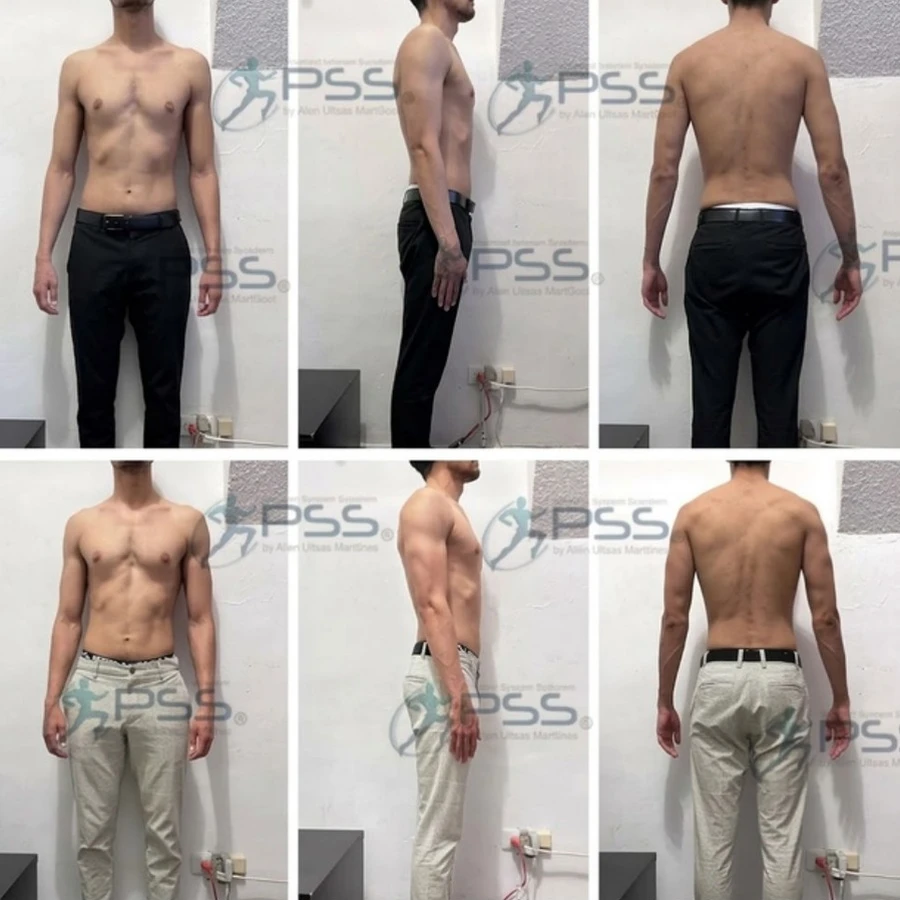 Resultados PSS - Recomposición Estética y Postural en 3 Ángulos